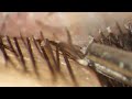 Removing entire demodex mites hiding in eyelashes