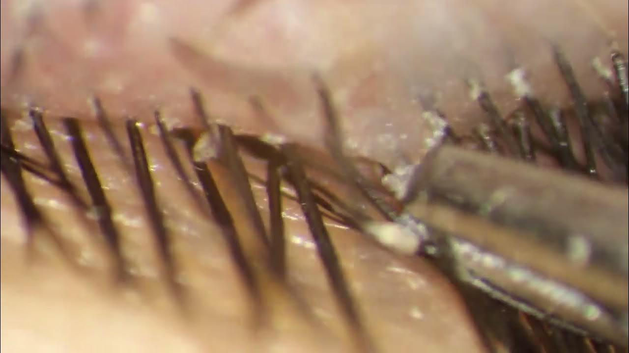 removing-entire-demodex-mites-hiding-in-eyelashes-youtube
