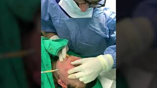 Surgical Face and Neck Lift -  الشد الجراحى للوجه والرقبه مع حقن الدهون الذاتية