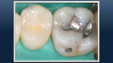 Class II composite restoration (exceptional marginal seal)