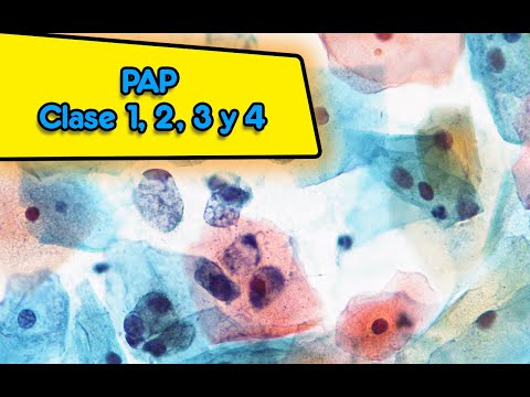 Como interpretar el resultado de papanicolaou según la Clase 1,2,3 o 4