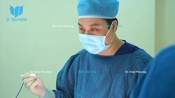 NÂNG MŨI CẤU TRÚC KẾT HỢP CẮT MÍ MẮT TRÊN TRONG CÙNG 1 LẦN PHẪU THUẬT.