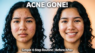  "Get Rid of Acne FAST: 4-Step Routine (Before/After Results!)
