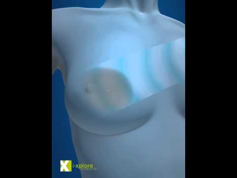 Breast Cancer Radiation Therapy