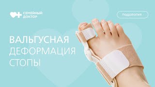 Как исправить вальгусную деформацию стопы?