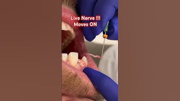 Live NERVES 😳!! Root Canal