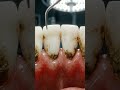 Removing Years of Tartar in One Visit 🦷 Deep Cleaning (Before & After) #dentalcare #oralhealth