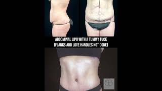 Tummy Tuck 3 Month Post-Op (Love Handles and Flanks Not Done)