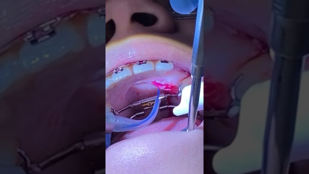 Exposed And Bond Procedure Impacted Canine Video 6 Tooth Time Family Dentistry New Braunfels TX