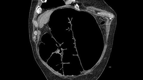 Sigmoid volvulus - CT findings