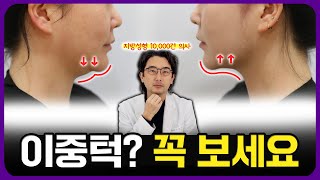 이중턱 지방흡입? 고민하시는 분들은 반드시 보세요. (지방성형 10,000건 의사)