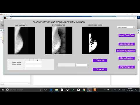 Classification of mammogram images by using CNN || Engineering Project || Final Year Project || IEEE