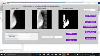 Classification of mammogram images by using CNN || Engineering Project || Final Year Project || IEEE