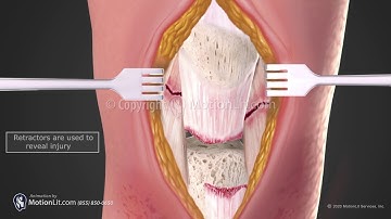 Patella Tendon Repair