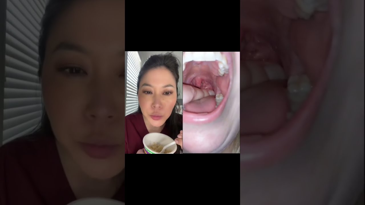 Dentist reacts to huge juicy tonsil stones  tonsilstones