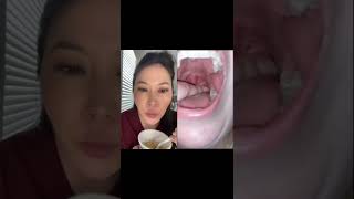 Dentist reacts to huge juicy tonsil stones #tonsilstones screenshot 5