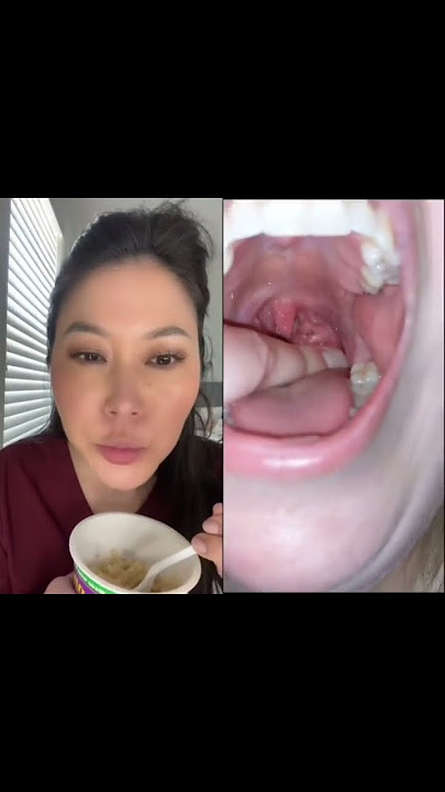Dentist reacts to huge juicy tonsil stones #tonsilstones