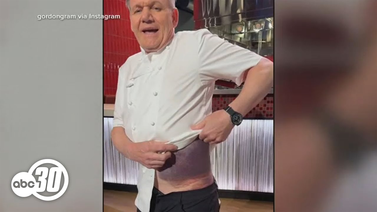 Gordon Ramsay says he's 'lucky' to be alive, shows off severe bruising ...