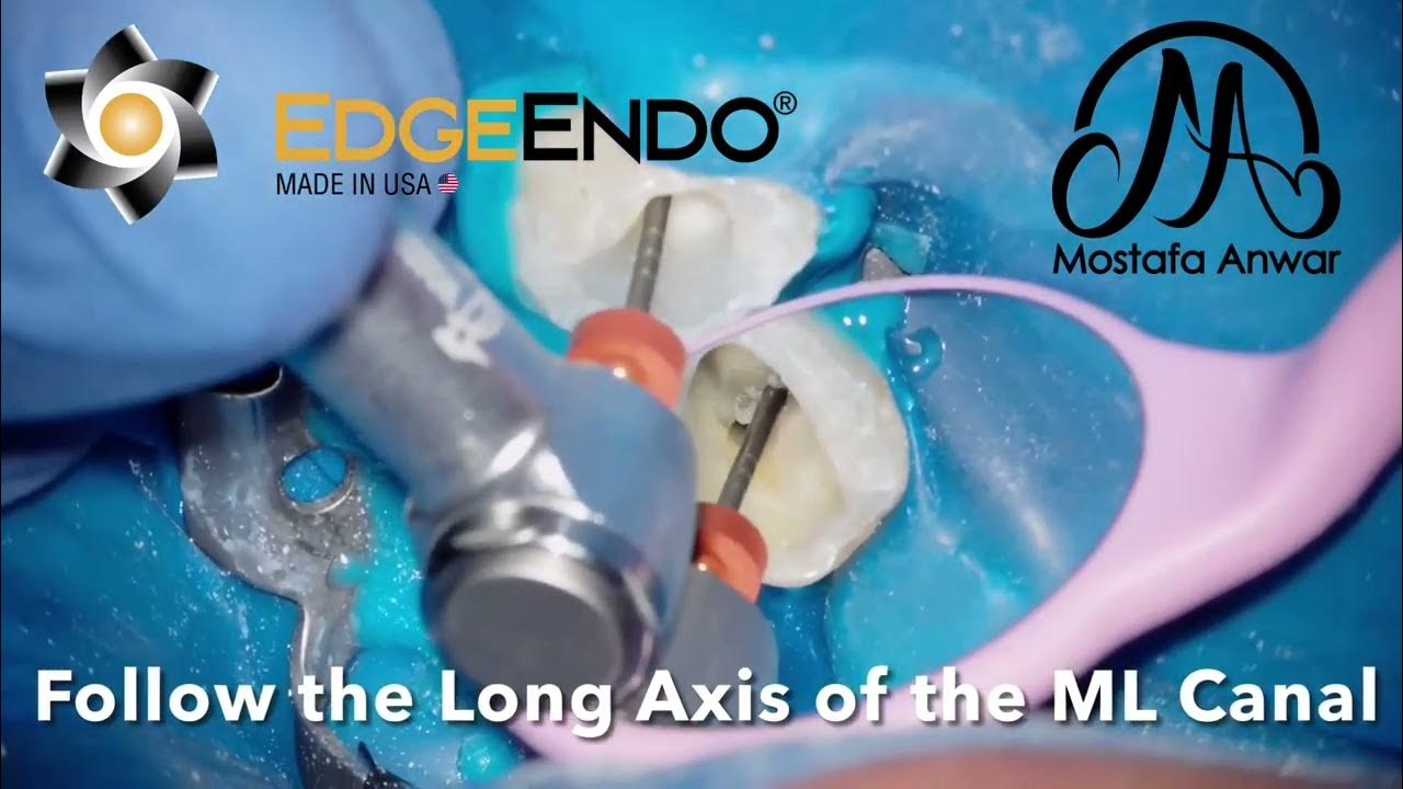 EdgeEndo® X7 file YouTube