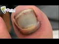 SMASHED and BLOODY TOE NAIL REMOVAL