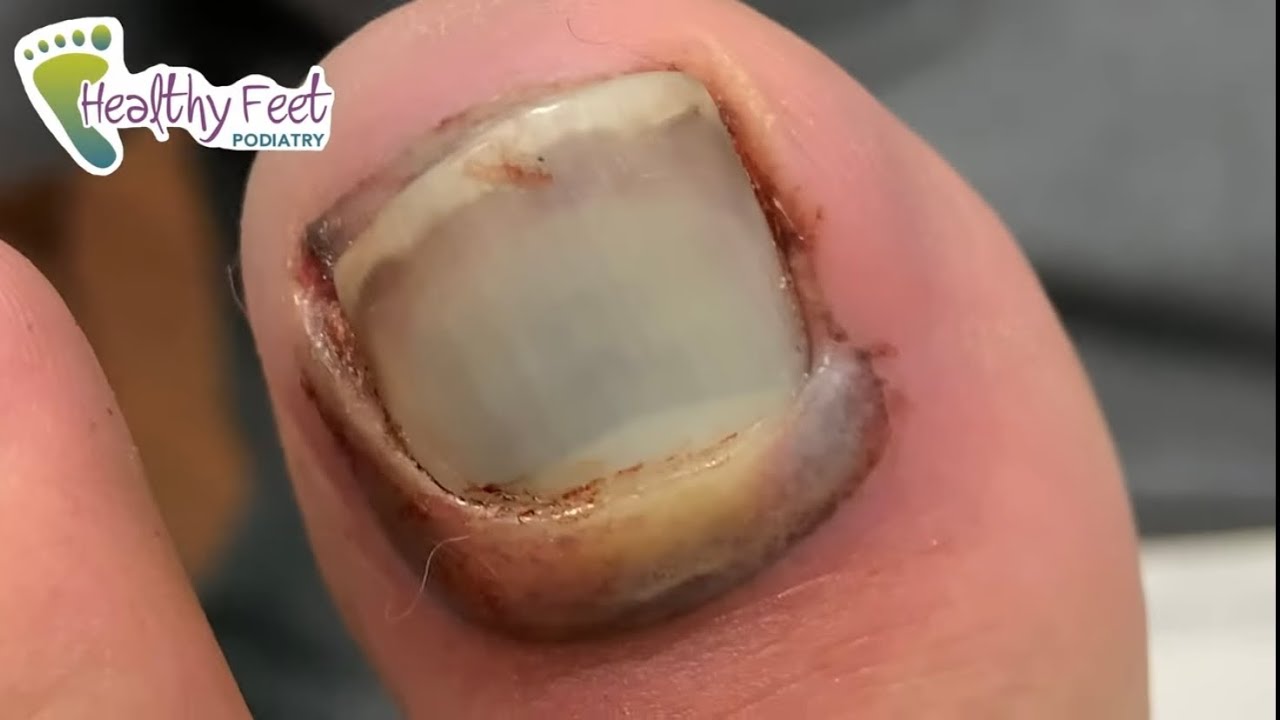 SMASHED and BLOODY TOE NAIL REMOVAL
