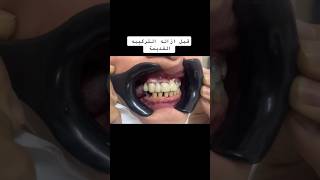 ازالة تركيبة اسنان قديمة واستبدالها بتركيبات جديده dr_abdullah_sultan_dentist dentist 소아치과 ortho
