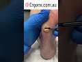 Slow motion corn and callus cutting from foot in podiatry clinic