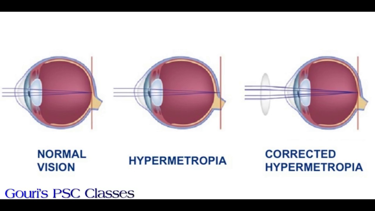 Что такое гиперметропия слабой степени