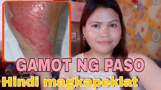 MABISANG GAMOT PARA SA PASO SA BALAT | HINDI MAGKAKA PEKLAT