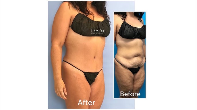 Tummy Tuck with Hernia Repair, Pubic Lift and Liposuction of the Mons Pubis.  