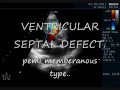 VSD-Peri membranus Type. ECHOCARDIOGRAPHY SERIES BY DR ANKUR  K. CHAUDHARI