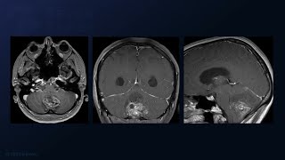 Suboccipital Craniotomy for Resection of a Vermian Glioneuronal Tumor