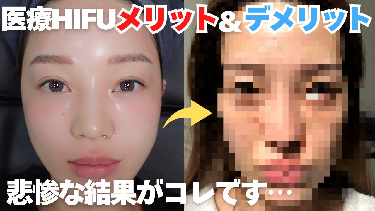 ハイフ】施術前にガチで見ろ!⚠️結末が悲惨な人の末路メリット 