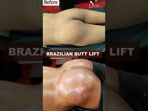 BBL Results Brazilian Butt Lift Immediate Before And After Divine Cosmetic Surgery