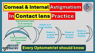 Corneal & Internal Astigmatism in Contact Lens Practice.