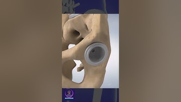 3D Animation of Hip Replacement Surgery: A Step-by-Step Guide
