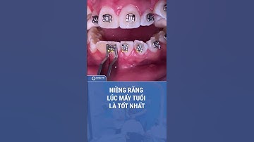 Độ tuổi niềng răng tốt nhấtI Nha Khoa Smile HT #niengrang #smileht #nhakhoa #nhakhoasmileht