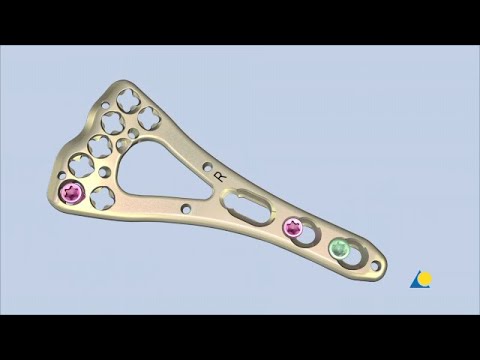 Radius, Distal - Intraarticular Fracture Fixation Using VA-LCP Volar Two-Column Distal Radius Plate