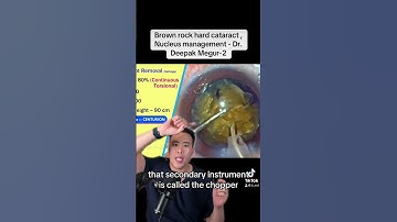 Cataract surgery explained by an eye surgeon #ophthalmology #optometry #cataract #cataractsurgery