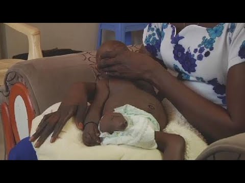 Birth defects surge in South Sudan