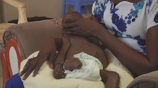Birth defects surge in South Sudan