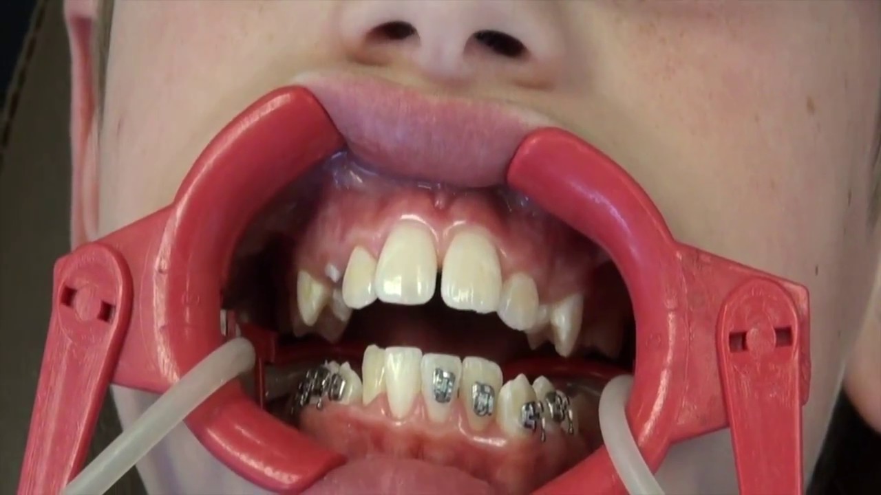 Getting Braces On Is Easy YouTube