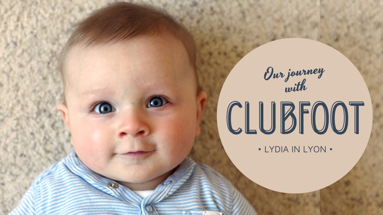 Our Son's Clubfoot Story : Plenty of Hope Ahead!