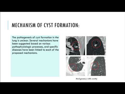 Cystic lung diseases-what may be the presentations