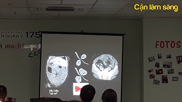 CT bệnh lý bụng cấp cứu không do chấn thương | Bs. Cao Thiên Tượng