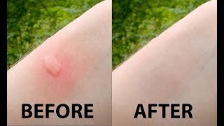 Got a bug bite today? bugs and mosquitoes can be quite pain annoying.
try these 7 simple home remedies with ingredients you find right in
your kitc...