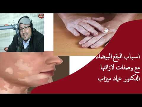 اسباب البقع البيضاء مع وصفات لازالتها الدكتور عماد ميزاب