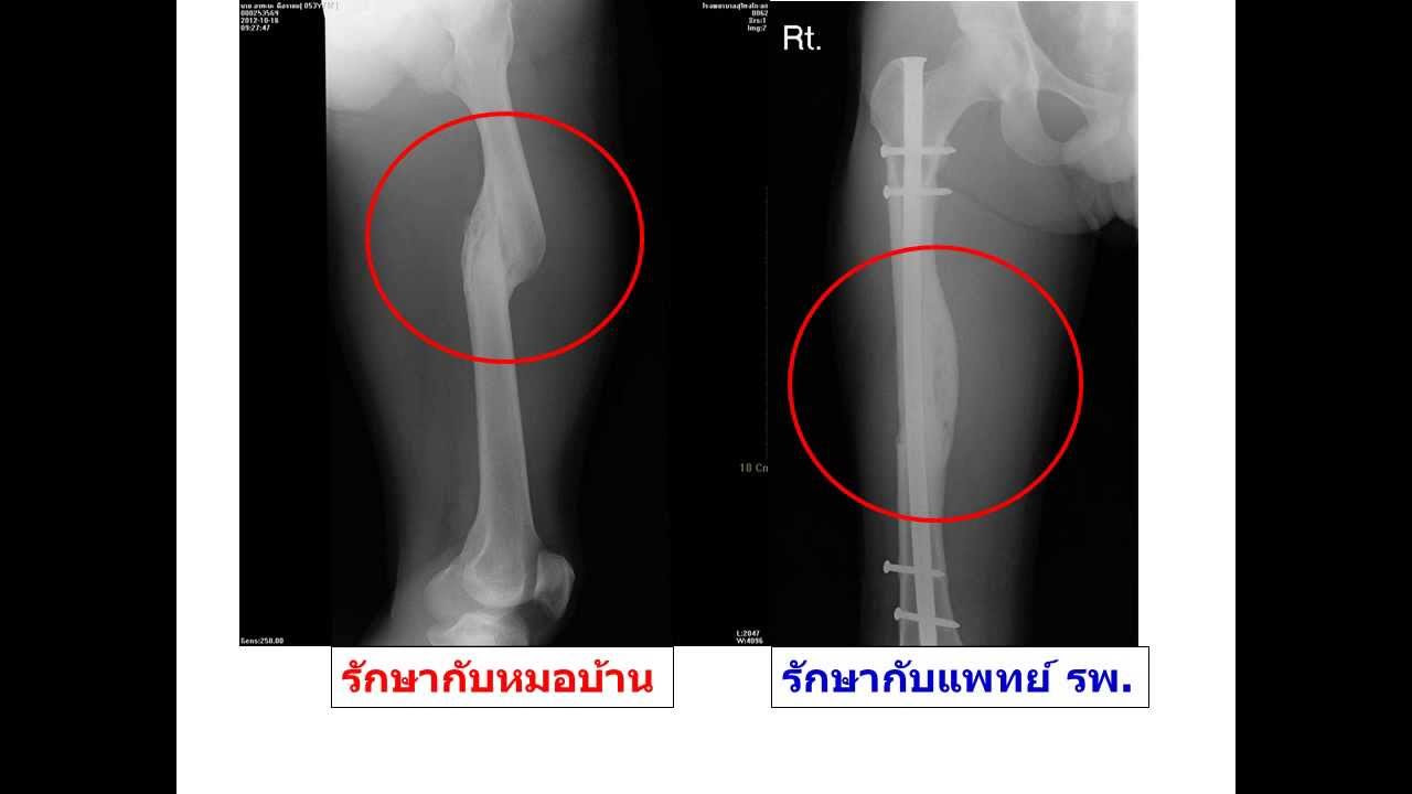 พยาธิ สภาพ กระดูก ต้น ขา หัก  Update  Ortho Kolok Hospital แนวทางการรักษาโรคกระดูกต้นขาหัก แบบไม่มีแผลเปิด