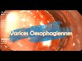 Les varices sophagiennes  traitement endoscopique