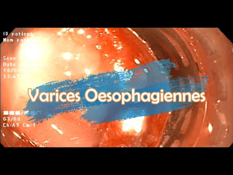 Les varices œsophagiennes : Traitement Endoscopique
